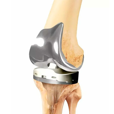 Эндопротезирование коленного сустава. Подготовка, проведение эндопротезирования, реабилитация